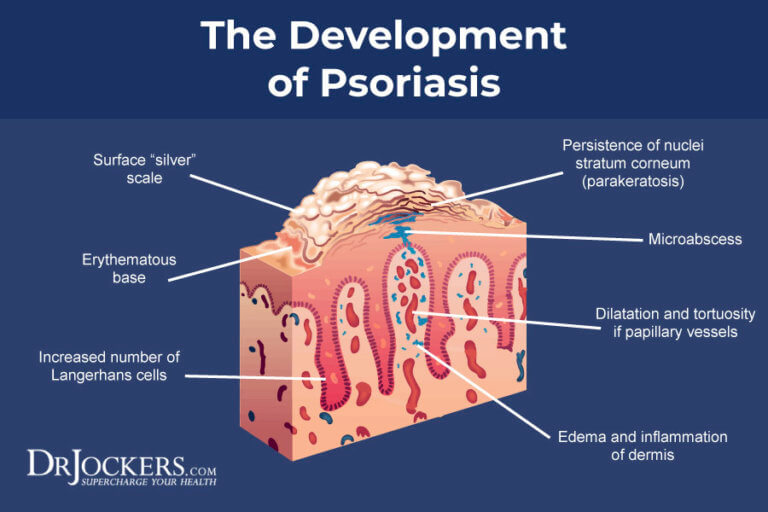 Seborrhiasis Psoriasis Seborrhoischer Typ _ Glycine soja sterol (INCI) – HKVZU