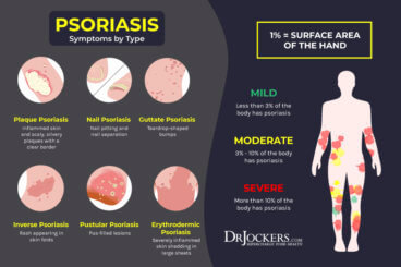 Psoriasis: Causes, Symptoms & Natural Support Strategies