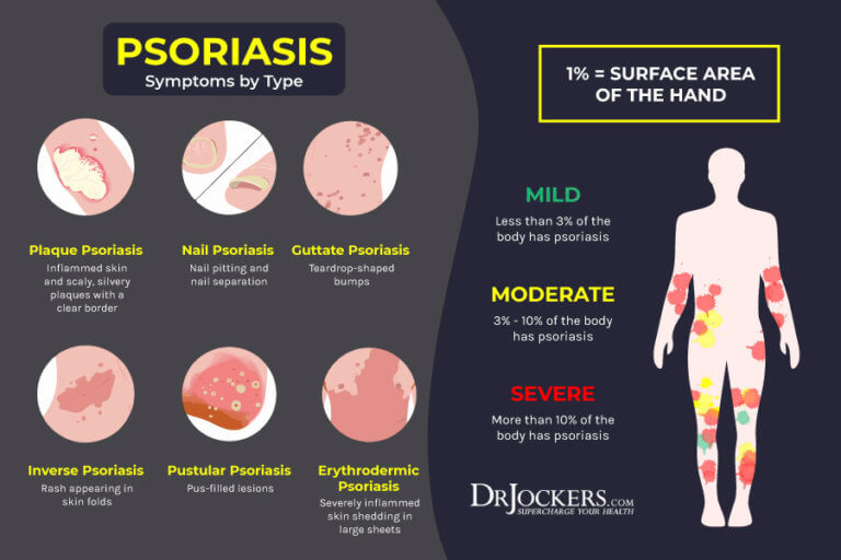 Psoriasis Causes, Symptoms & Natural Support Strategies