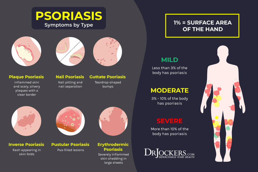 Psoriasis, Psoriasis:  Causes, Symptoms &#038; Natural Support Strategies