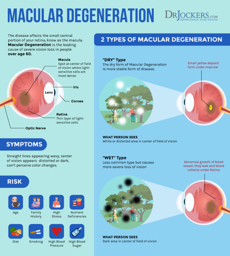 Macular Degeneration: Causes, Symptoms & Natural Strategies