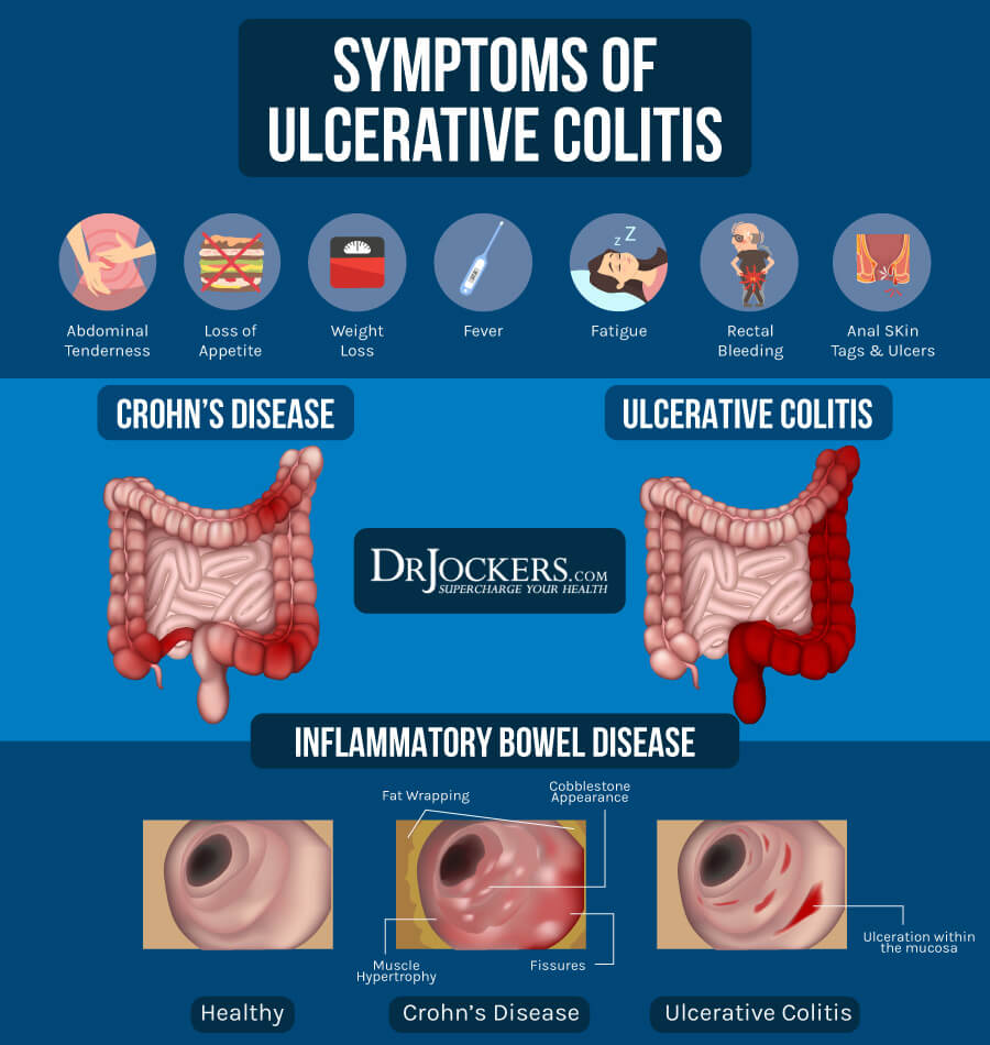 clinical presentation of ulcerative colitis