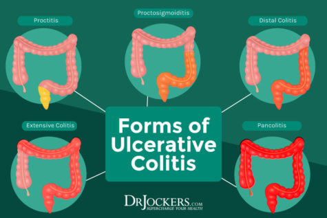 Ulcerative Colitis: Causes, Symptoms and Support Strategies