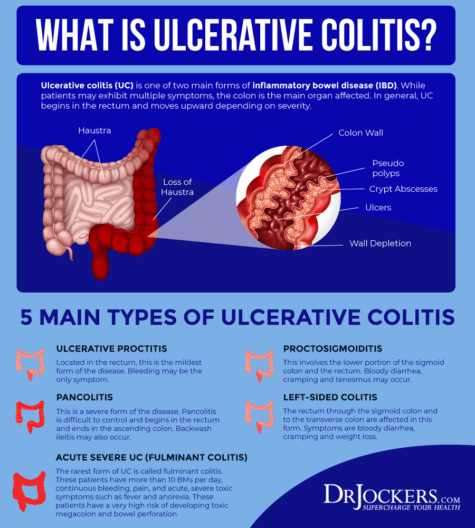 Ulcerative Colitis: Causes, Symptoms and Support Strategies