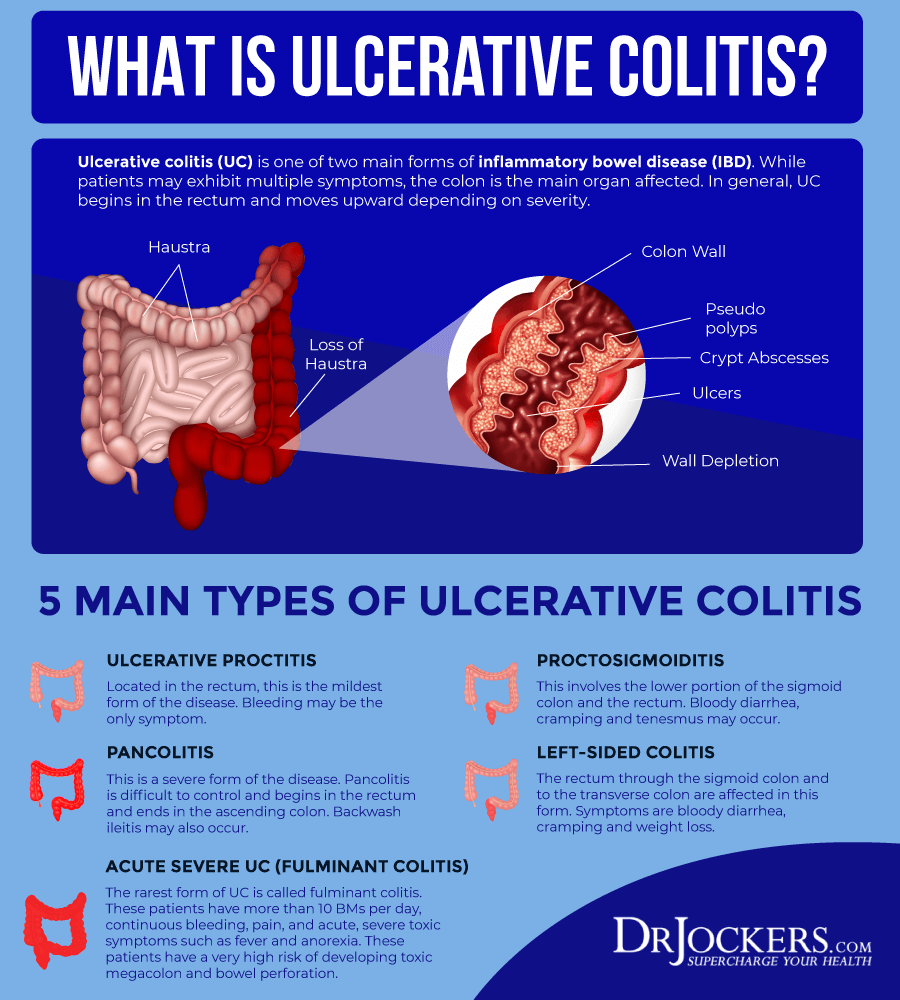 Ulcerative Colitis, Ulcerative Colitis: Causes, Symptoms and Natural Support Strategies