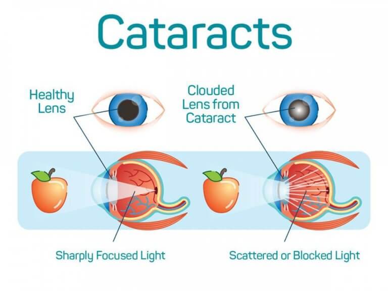 Cataracts Causes, Symptoms & Natural Support Strategies