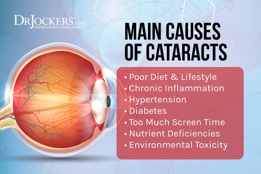 Cataracts, Cataracts:  Causes, Symptoms &#038; Natural Support Strategies