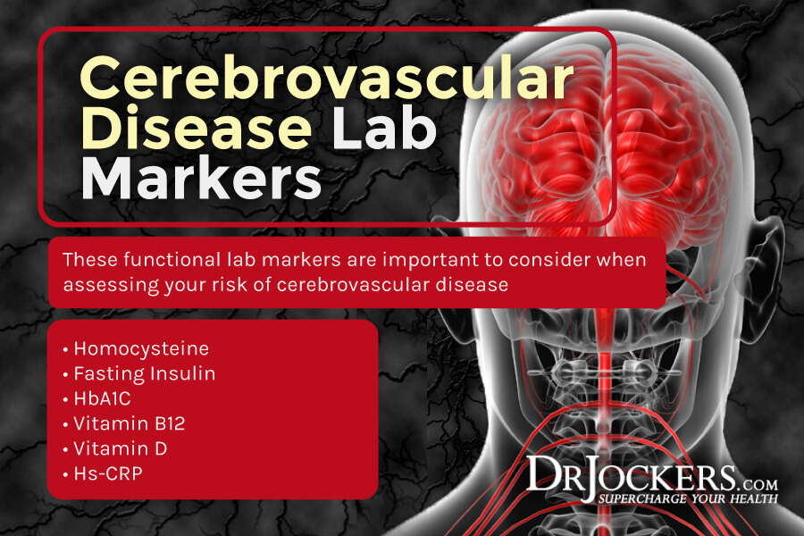 cerebrovascular disease, Cerebrovascular Disease:  Causes, Symptoms &#038; Support Strategies