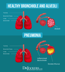 Pneumonia: Causes, Symptoms & Support Strategies - DrJockers.com