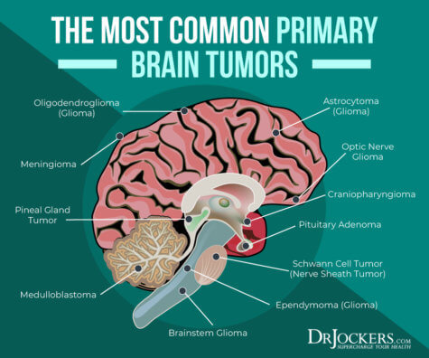 Brain Cancer: Natural Strategies to Help the Fight - DrJockers.com