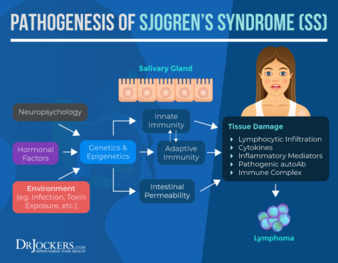 Sjogren’s Syndrome: Symptoms, Causes, and Support Strategies