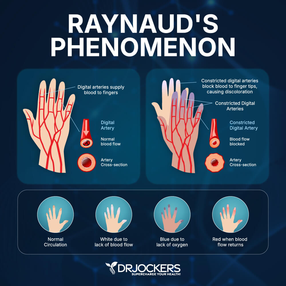 raynaud's