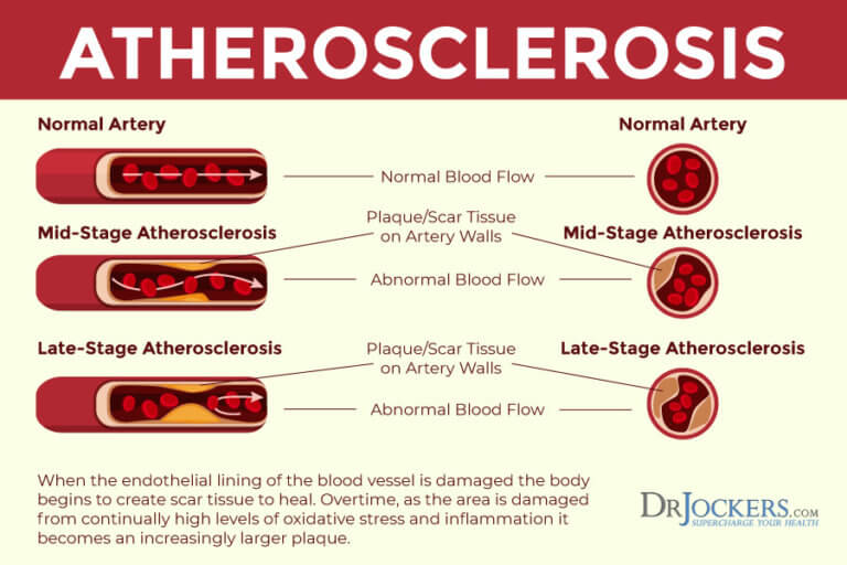 Clogged Arteries Causes, Symptoms & Support Strategies