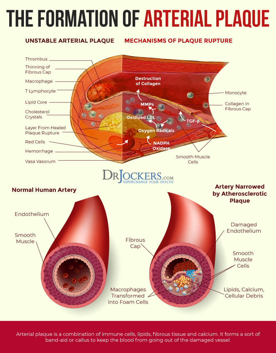 clogged arteries, Clogged Arteries:  Causes, Symptoms &#038; Support Strategies