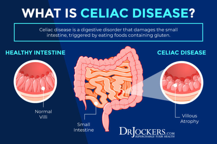 celiac-disease-symptoms-causes-and-natural-support-strategies