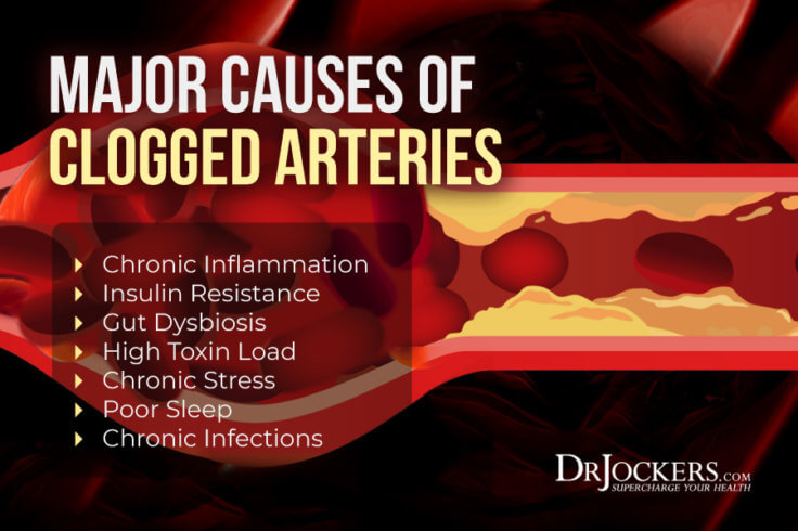 clogged-arteries-causes-symptoms-support-strategies