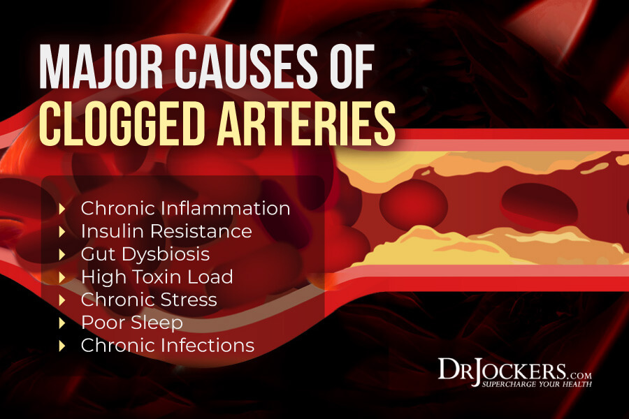 clogged arteries, Clogged Arteries:  Causes, Symptoms &#038; Support Strategies
