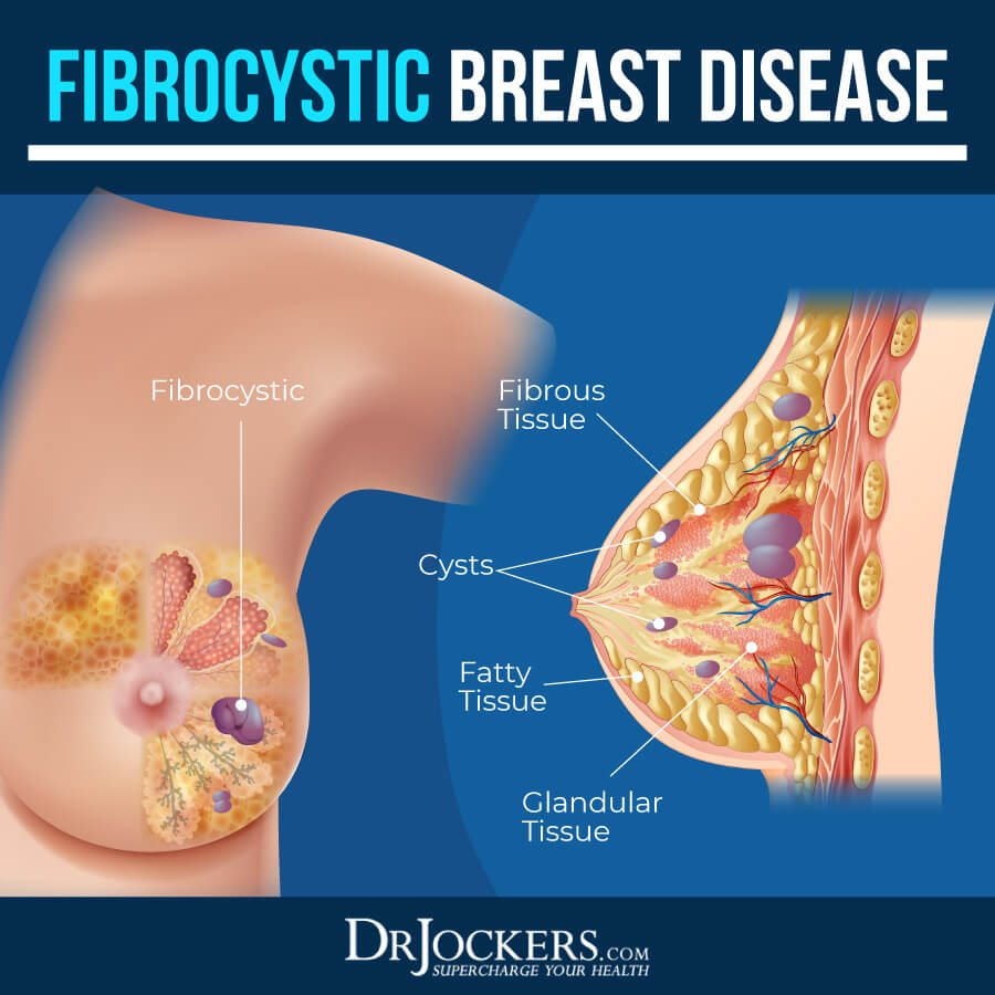 Why is it called fibrocystic breast 'disease' if it is common and