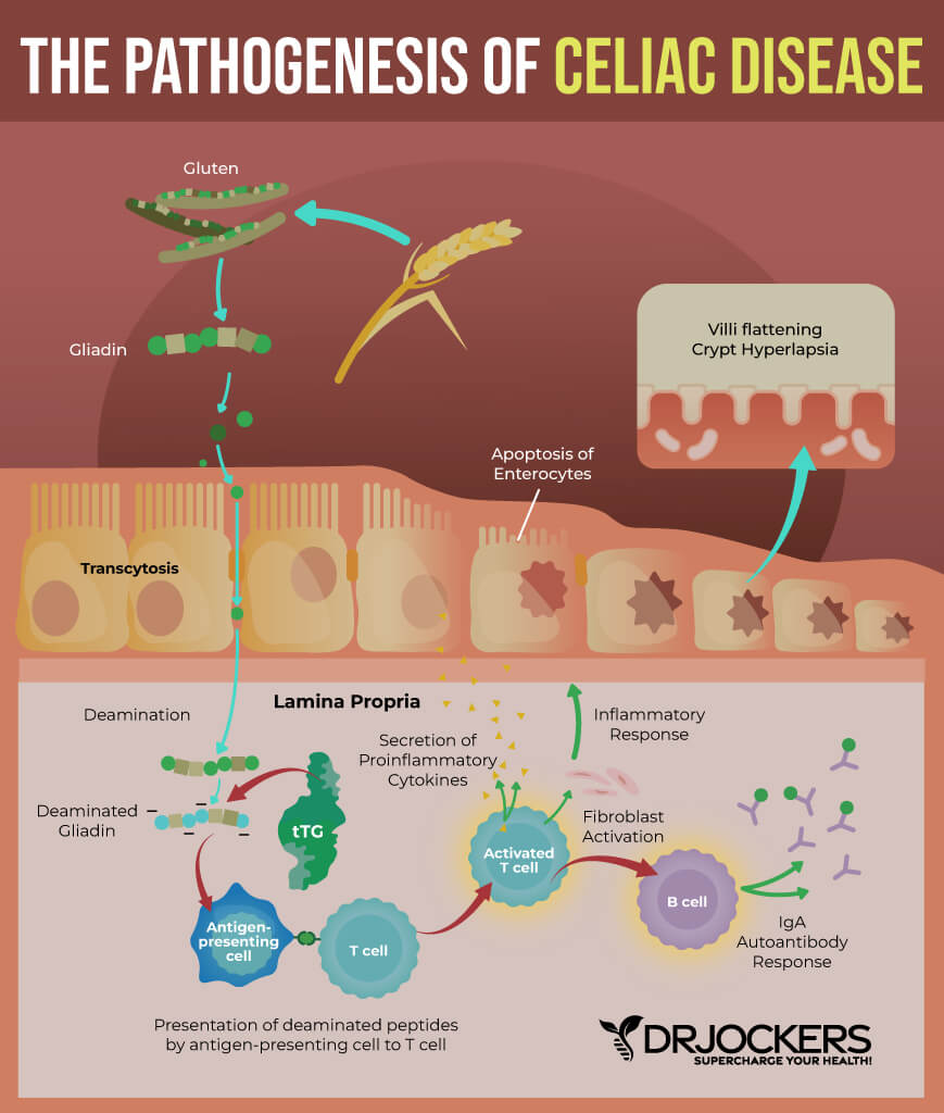 celiac disease