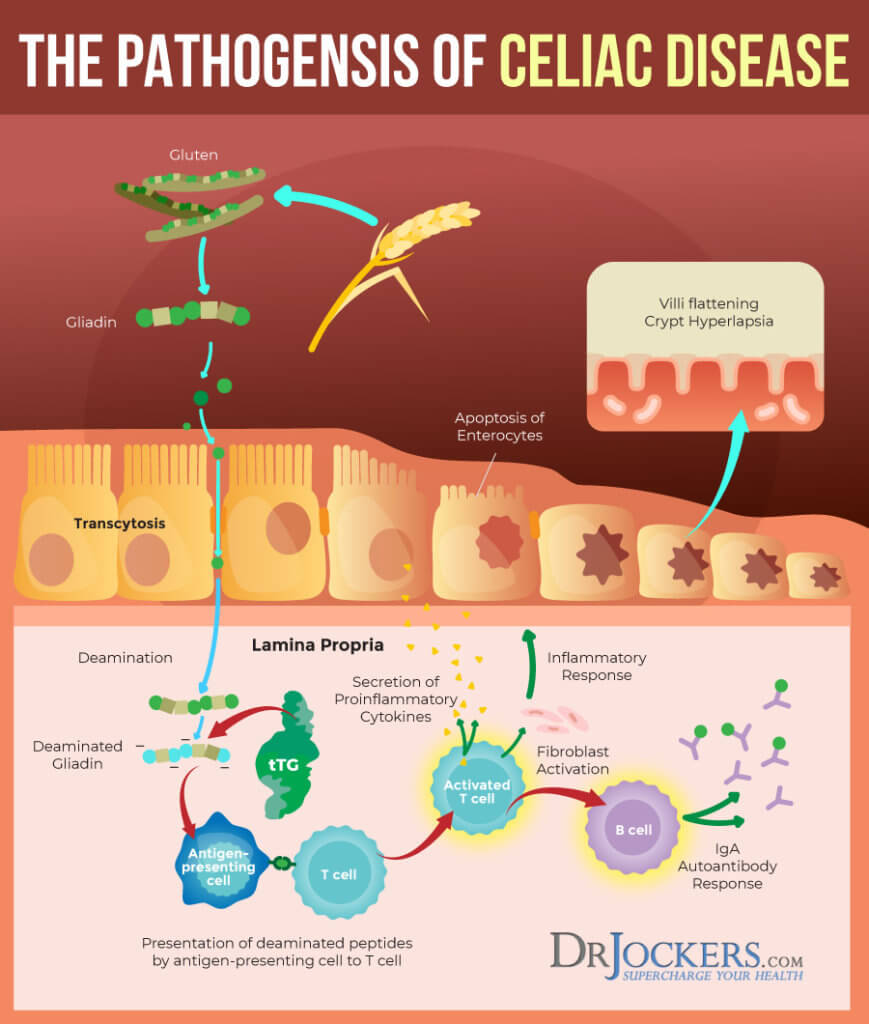 Celiac Disease Symptoms Causes And Natural Support Strategies