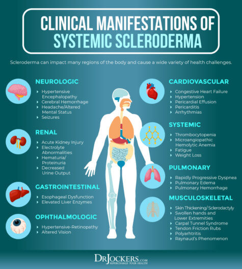 Scleroderma: Causes, Symptoms and Natural Support Strategies