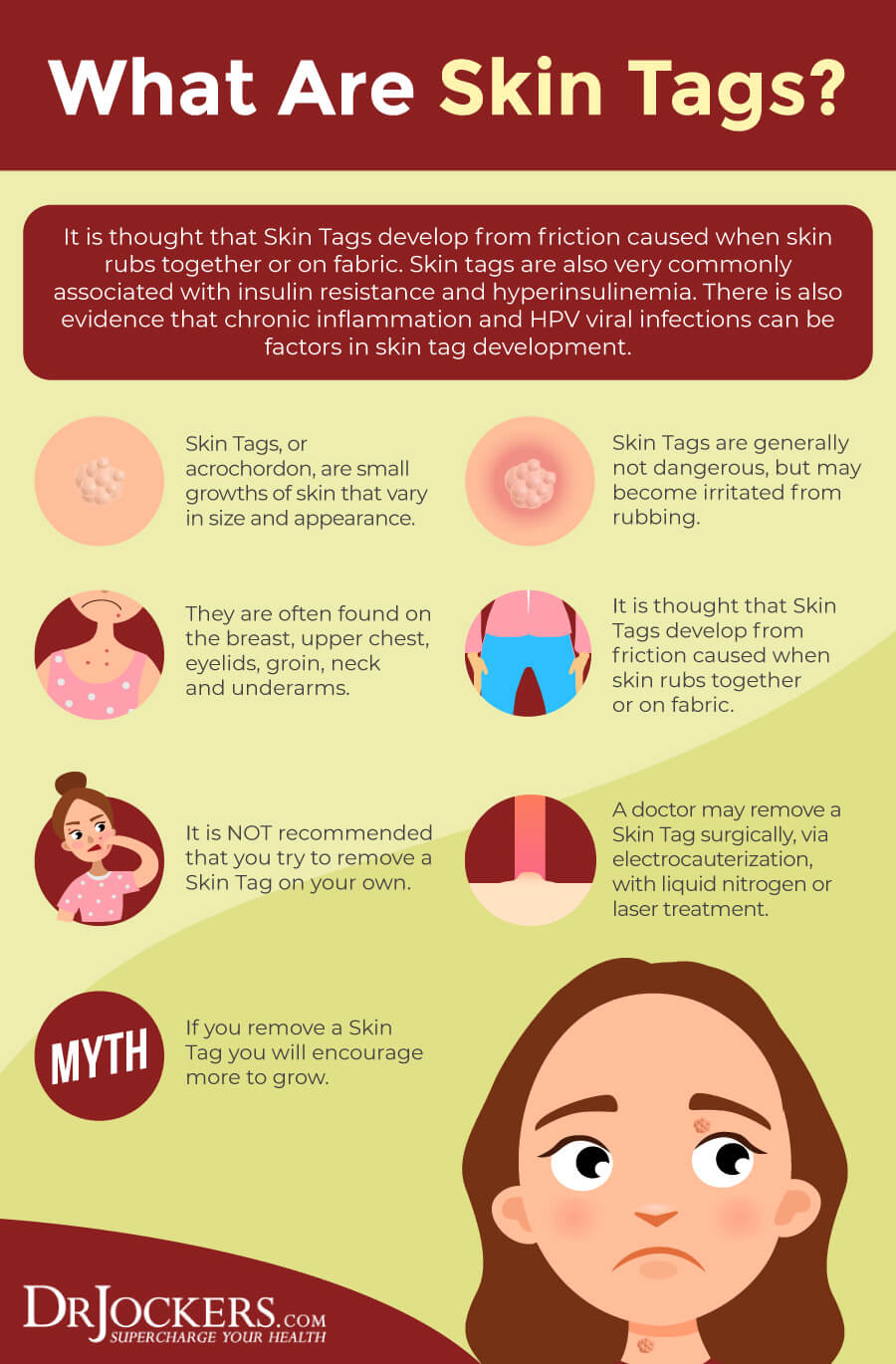 Skin Tags Major Causes And Natural Support Strategies DrJockers