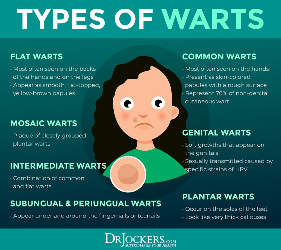 warts, Skin Warts: Major Causes and Natural Support Strategies
