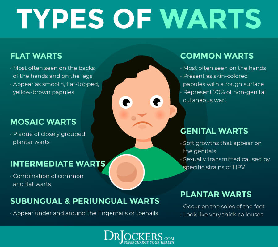 Warts Signs And Symptoms And Treatment Infoupdate