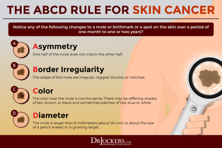 Skin Cancer Symptoms, Causes and Natural Support Strategies