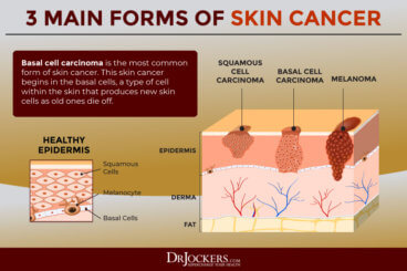 Skin Cancer: Symptoms, Causes and Natural Support Strategies