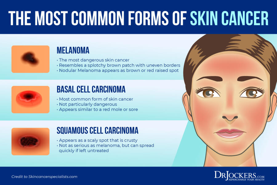 skin cancer, Skin Cancer: Symptoms, Causes, and Natural Support Strategies