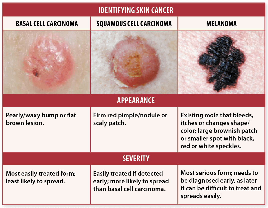 Skin Cancer Symptoms Causes And Natural Support Strategies