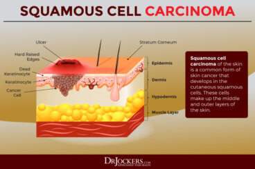 Skin Cancer: Symptoms, Causes and Natural Support Strategies