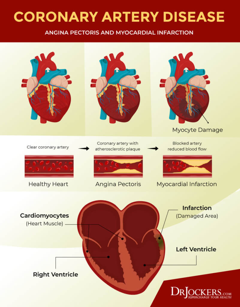 Cardiac Autophagy: Healing Damaged Heart Cells - DrJockers.com