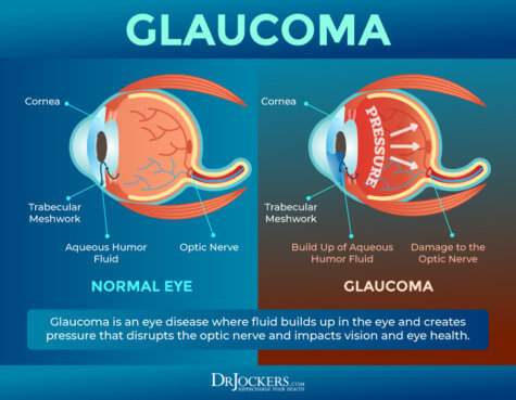 Glaucoma: Symptoms, Causes and Natural Support Strategies