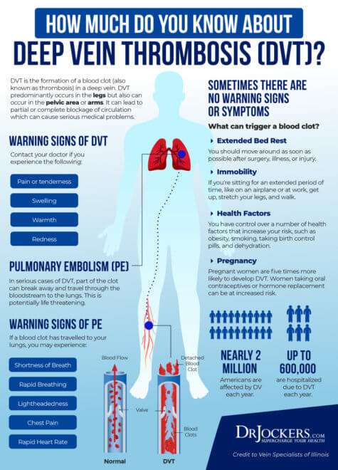 Deep Vein Thrombosis: Causes, Symptoms and Support Strategies