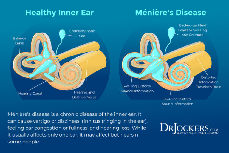 Ménière's Disease: Causes, Symptoms & Support Strategies