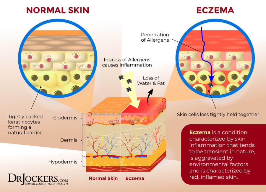 Eczema Symptoms Causes Support Strategies DrJockers Eczema Symptoms Causes Support Strategies DrJockers