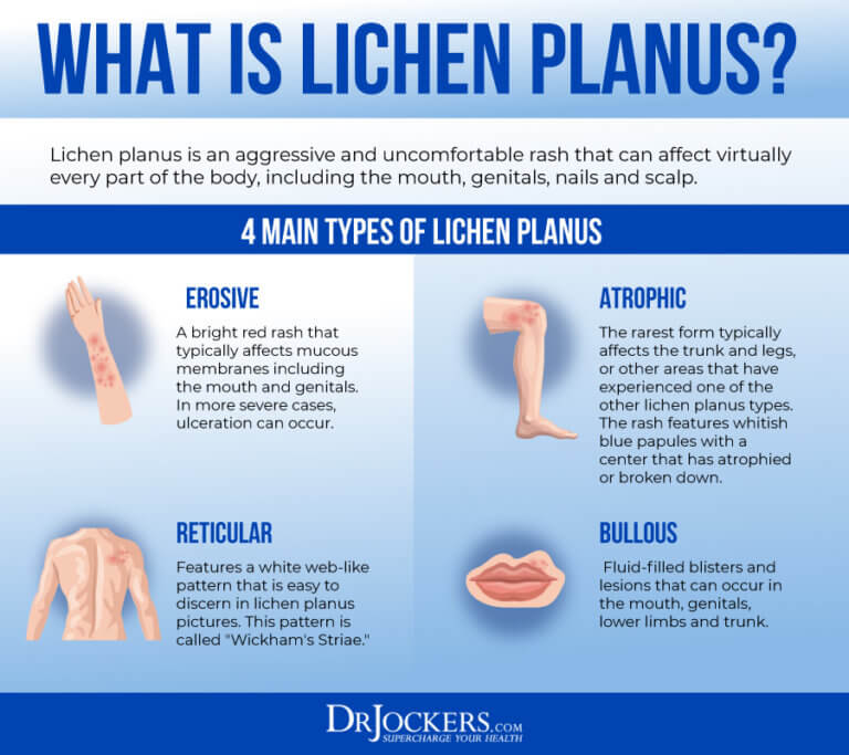 Lichen Planus: Symptoms, Causes And Support Strategies