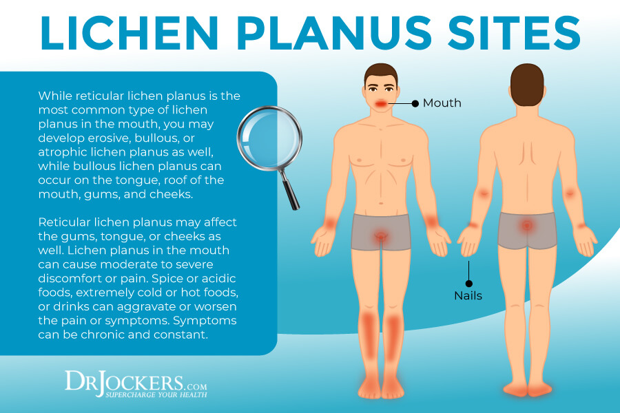 lichen, Lichen Planus: Symptoms, Causes &#038; Support Strategies