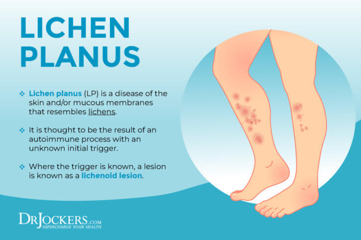 Lichen Planus Symptoms Causes And Support Strategies