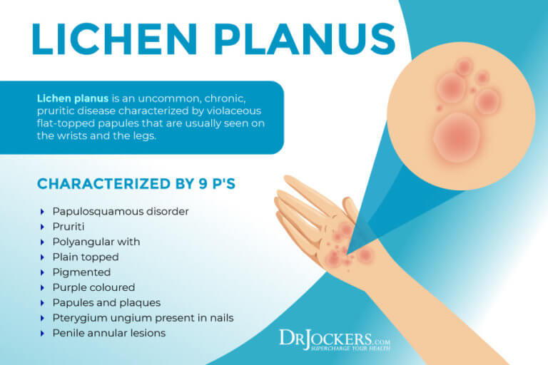 Lichen Planus Symptoms, Causes and Support Strategies