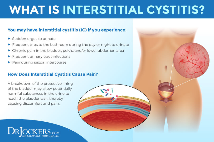 interstitial cystitis