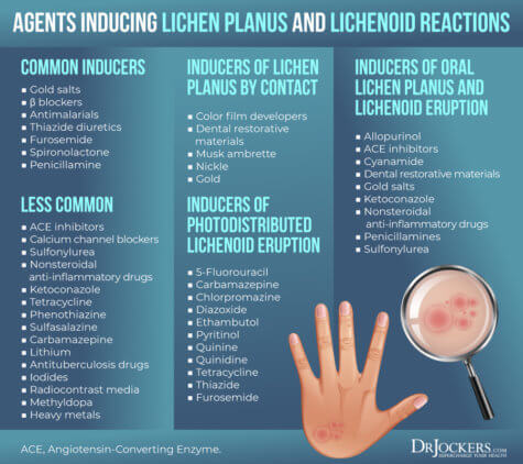 Lichen Planus: Symptoms, Causes and Support Strategies