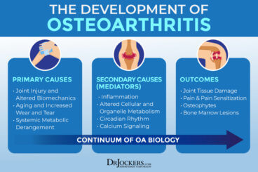 Osteoarthritis: Symptoms, Causes and Natural Support Strategies