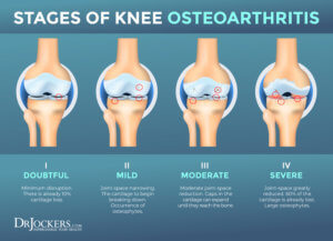 Osteoarthritis: Symptoms, Causes and Natural Support Strategies