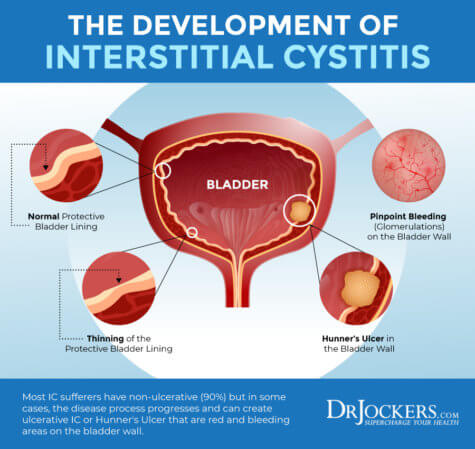 Interstitial Cystitis: Symptoms, Causes And Support Strategies