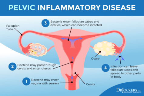 Interstitial Cystitis: Symptoms, Causes and Support Strategies