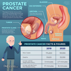 Prostate Cancer: Symptoms, Causes and Support Strategies