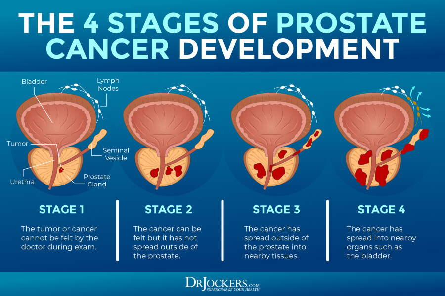 prostate cancer, Prostate Cancer: Symptoms, Causes, and Support Strategies